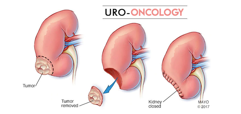 Uro-Oncology