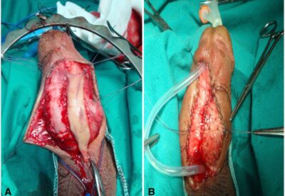 BUCCAL-MUCOSAL-URETHROPLASTY